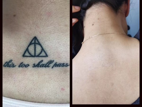 Tattoo Removal